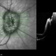 Papilledema Papilledema
